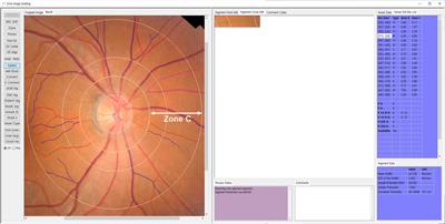 The role of retinal vessel geometry as an indicator of systemic arterial stiffness assessed by cardio-ankle vascular index